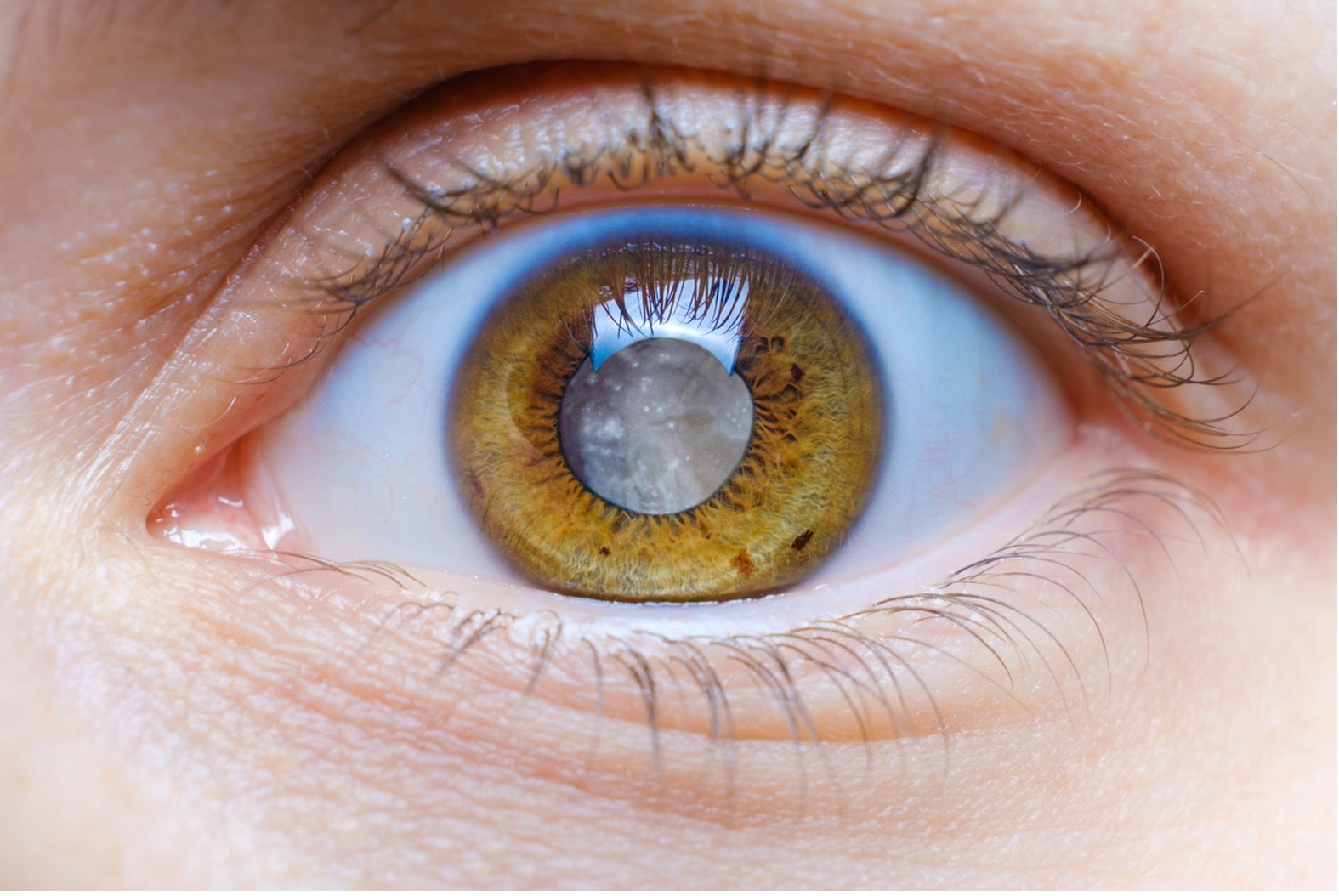 When Should You Get Cataract Surgery?