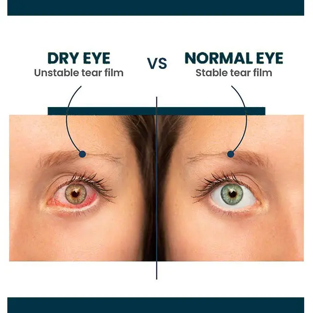 Healthy vs dry eye tear film comparison