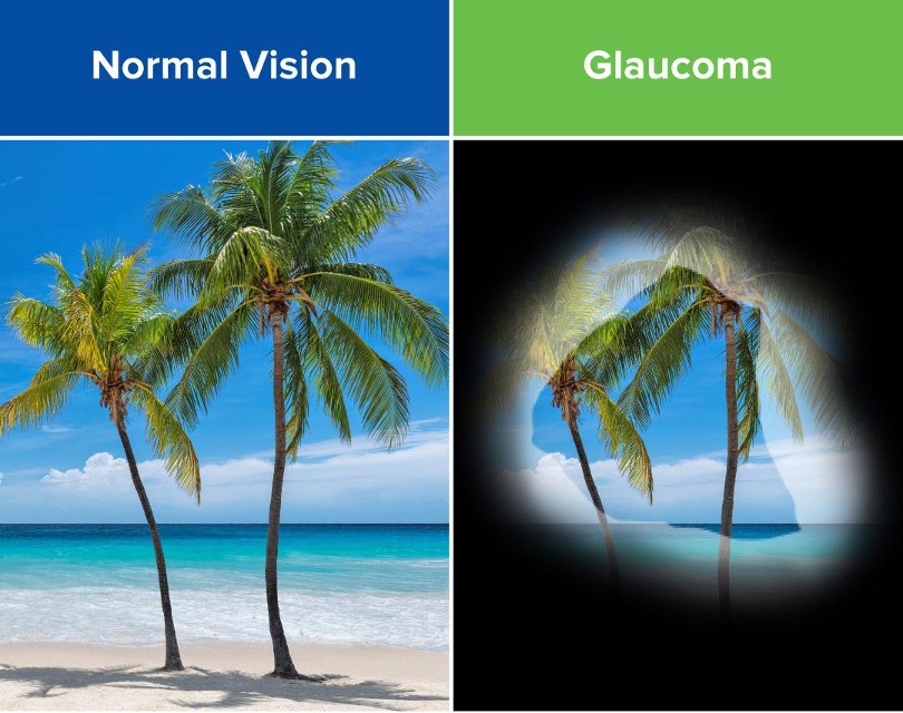 Vision Loss Progression - Glaucoma