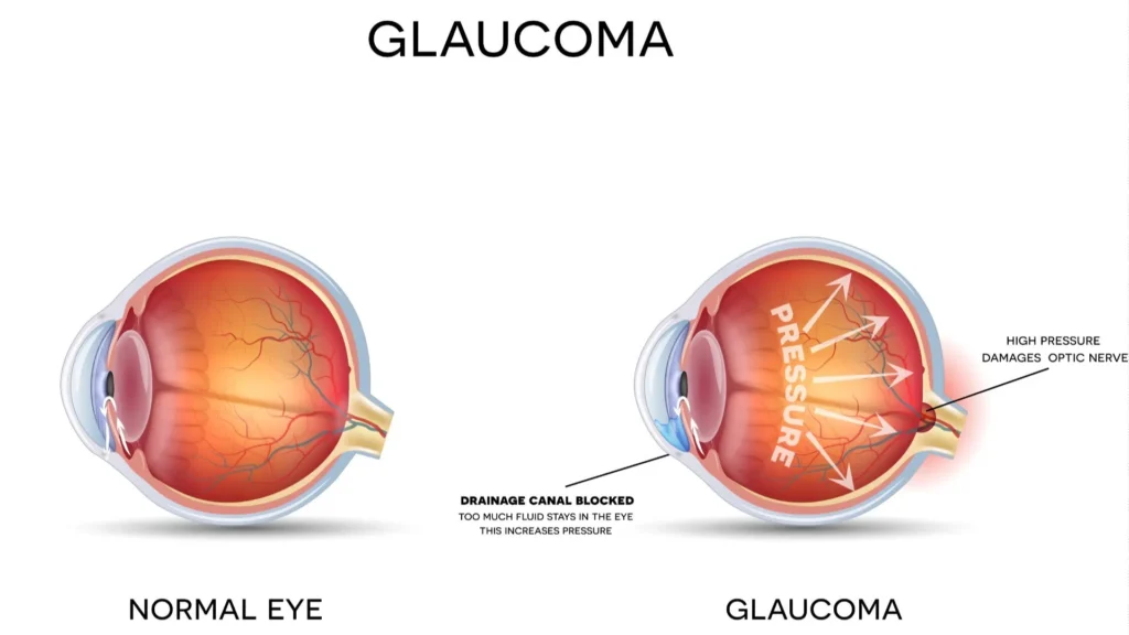 Optic Nerve Diagram - Glaucoma